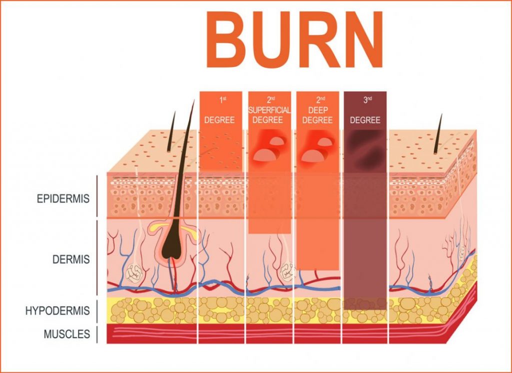 How to treat a burn