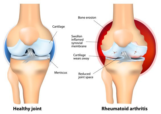 Arthritis Medication