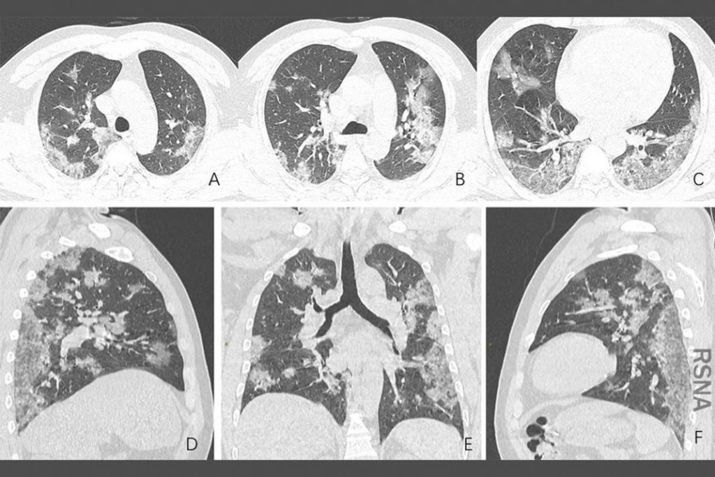 1800x1200 coronavirus lung effects scaled