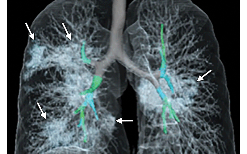 What Coronavirus Does to the Lungs | Magazineup