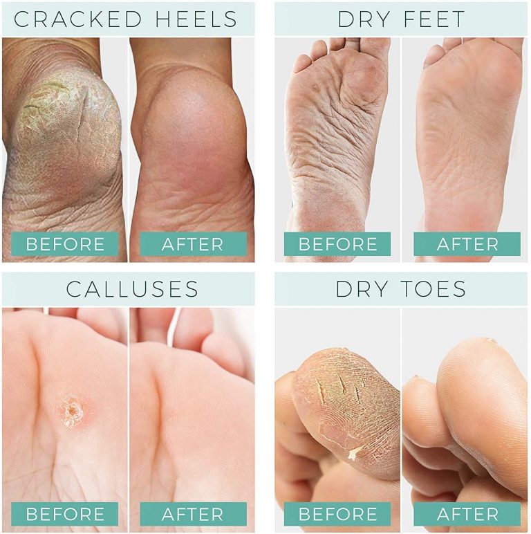Foot Peel Mask