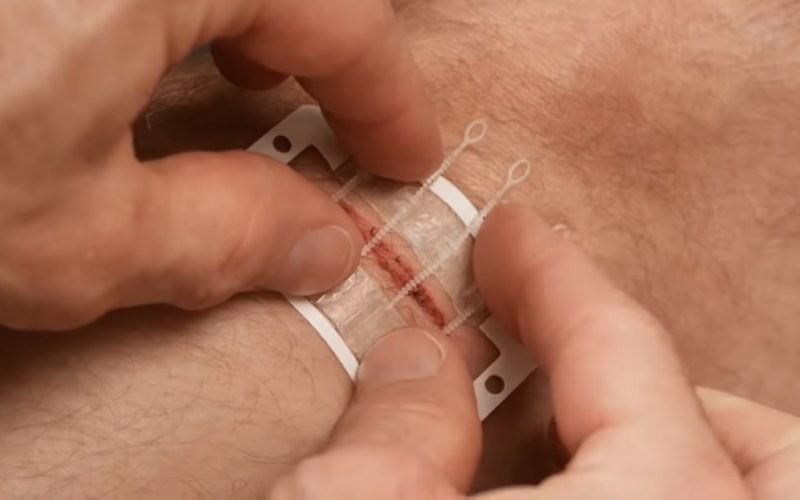 Zip stitch Bandage