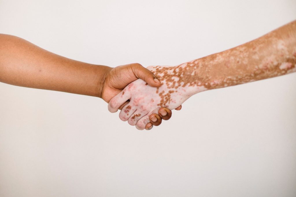 Vitiligo-Can I Stop the Spread of Vitiligo?