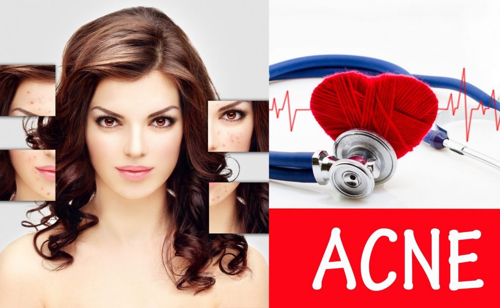 Acne Diet