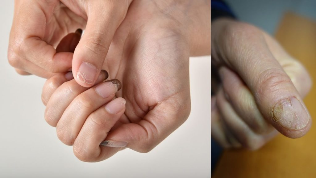 Nail Psoriasis